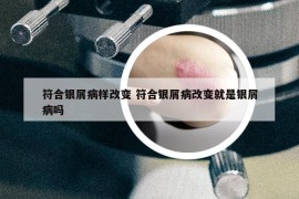 符合銀屑病樣改變 符合銀屑病改變就是銀屑病嗎
