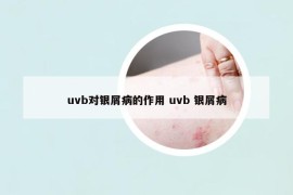 uvb對銀屑病的作用 uvb 銀屑病