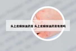 頭上皮癬抹油藥膏 頭上皮癬抹油藥膏有用嗎