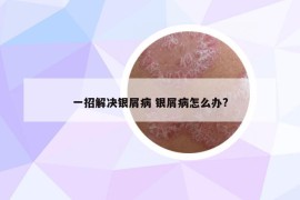 一招解決銀屑病 銀屑病怎么辦?