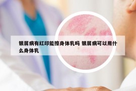 銀屑病有紅印能擦身體乳嗎 銀屑病可以用什么身體乳