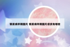 銀屑病早期圖片 銀屑病早期圖片癥狀有哪些