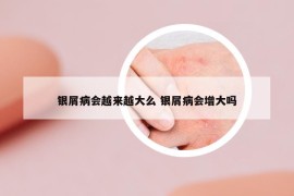 銀屑病會越來越大么 銀屑病會增大嗎