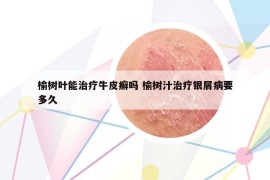 榆樹葉能治療牛皮癬嗎 榆樹汁治療銀屑病要多久