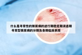 什么是尋常性的銀屑病的進行期穩(wěn)定期消退期 尋常型銀屑病的分期及各期臨床表現(xiàn)