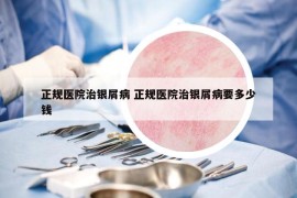 正規(guī)醫(yī)院治銀屑病 正規(guī)醫(yī)院治銀屑病要多少錢(qián)
