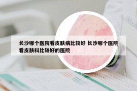 長(zhǎng)沙哪個(gè)醫(yī)院看皮膚病比較好 長(zhǎng)沙哪個(gè)醫(yī)院看皮膚科比較好的醫(yī)院