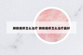腳膿皰疹怎么治療 腳膿皰疹怎么治療最好