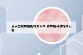 點滴型銀屑病能吃大頭菜 銀屑病可以吃菜心嗎