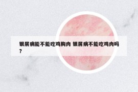 銀屑病能不能吃雞胸肉 銀屑病不能吃雞肉嗎?