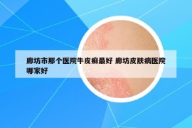 廊坊市那個(gè)醫(yī)院牛皮癬最好 廊坊皮膚病醫(yī)院哪家好
