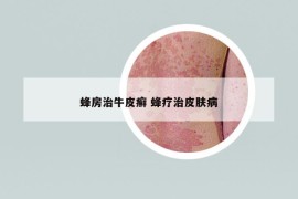 蜂房治牛皮癬 蜂療治皮膚病