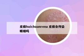 皮癬huichuanrena 皮癬會傳染眼睛嗎