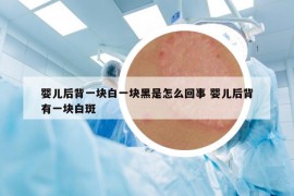 嬰兒后背一塊白一塊黑是怎么回事 嬰兒后背有一塊白斑