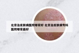 北京治皮膚病醫(yī)院哪家好 北京治皮膚病?？漆t(yī)院哪家最好