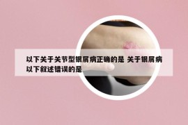 以下關(guān)于關(guān)節(jié)型銀屑病正確的是 關(guān)于銀屑病以下敘述錯誤的是