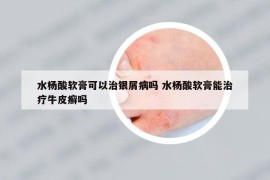 水楊酸軟膏可以治銀屑病嗎 水楊酸軟膏能治療牛皮癬嗎