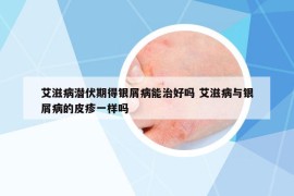 艾滋病潛伏期得銀屑病能治好嗎 艾滋病與銀屑病的皮疹一樣嗎