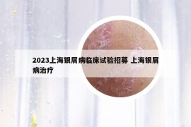 2023上海銀屑病臨床試驗招募 上海銀屑病治療