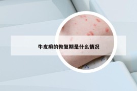 牛皮癬的恢復(fù)期是什么情況