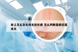 身上怎么會(huì)無緣無故長癬 怎么判斷是癬還是皮炎