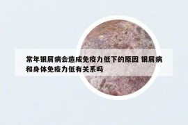 常年銀屑病會造成免疫力低下的原因 銀屑病和身體免疫力低有關(guān)系嗎