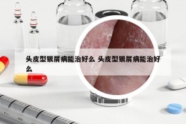 頭皮型銀屑病能治好么 頭皮型銀屑病能治好么
