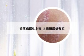 銀屑病醫(yī)生上海 上海銀屑病專(zhuān)家