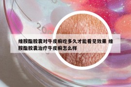 維胺酯膠囊對牛皮癬吃多久才能看見效果 維胺酯膠囊治療牛皮癬怎么樣