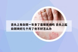 舌頭上有白斑一年多了是銀屑病嗎 舌頭上起白斑塊好幾個月了也不好怎么辦