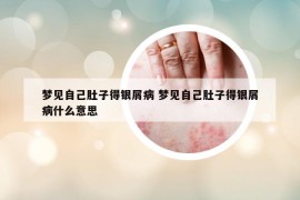 夢見自己肚子得銀屑病 夢見自己肚子得銀屑病什么意思