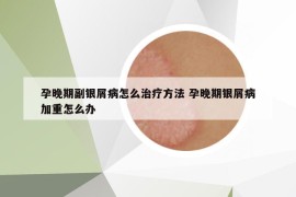 孕晚期副銀屑病怎么治療方法 孕晚期銀屑病加重怎么辦