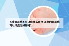 兒童銀屑病不可以吃什么食物 兒童的銀屑病可以徹底治好好嗎?
