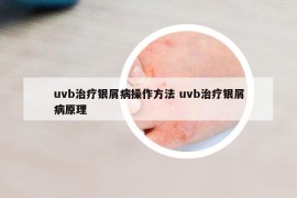 uvb治療銀屑病操作方法 uvb治療銀屑病原理