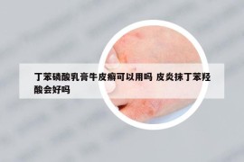 丁苯磷酸乳膏牛皮癬可以用嗎 皮炎抹丁苯羥酸會(huì)好嗎