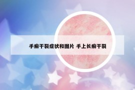 手癬干裂癥狀和圖片 手上長癬干裂