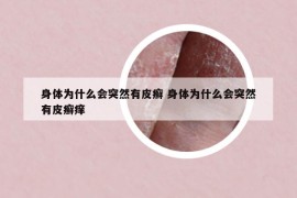 身體為什么會突然有皮癬 身體為什么會突然有皮癬癢