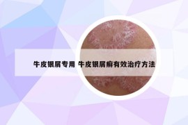 牛皮銀屑專用 牛皮銀屑癬有效治療方法