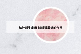 肽針劑牛皮癬 肽對銀屑病的作用