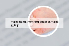 牛皮癬有17年了會不會變皮膚癌 患牛皮癬31年了