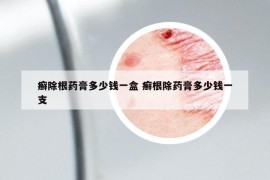 癬除根藥膏多少錢一盒 癬根除藥膏多少錢一支