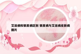 艾滋病和銀屑病區(qū)別 銀屑病與艾滋病皮膚病圖片
