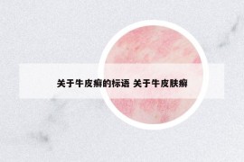 關(guān)于牛皮癬的標(biāo)語 關(guān)于牛皮膚癬