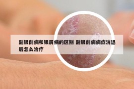 副銀削病和銀屑病的區(qū)別 副銀削病病癥消退后怎么治療