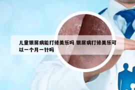 兒童銀屑病能打修美樂(lè)嗎 銀屑病打修美樂(lè)可以一個(gè)月一針嗎