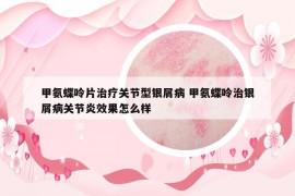 甲氨蝶呤片治療關(guān)節(jié)型銀屑病 甲氨蝶呤治銀屑病關(guān)節(jié)炎效果怎么樣