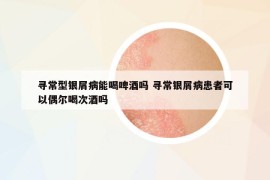 尋常型銀屑病能喝啤酒嗎 尋常銀屑病患者可以偶爾喝次酒嗎