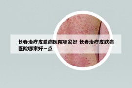 長(zhǎng)春治療皮膚病醫(yī)院哪家好 長(zhǎng)春治療皮膚病醫(yī)院哪家好一點(diǎn)
