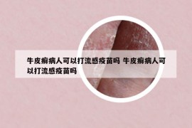 牛皮癬病人可以打流感疫苗嗎 牛皮癬病人可以打流感疫苗嗎