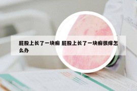 屁股上長了一塊癬 屁股上長了一塊癬很癢怎么辦